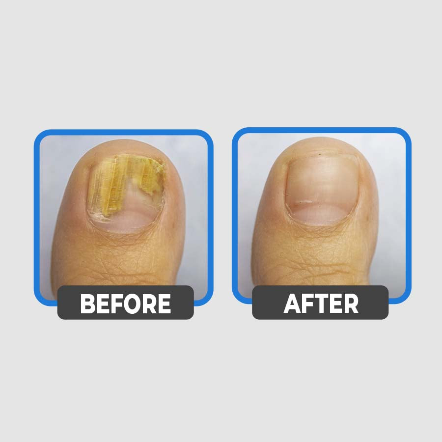 Nail Fungus Treatment Oil